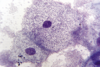 Рисунок. Мікрофотографія «ключової» клітини (забарвлення за методом Романовського)