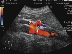 Рис. 2. Эхограмма того же пациента с использованием режима ЦДК: 1 — аорта; 2 — верхняя мезентериальная артерия; 3 — ЧС; 4 — элайзинг-эффект, маркирующий зону стеноза в области сдавления ЧС медиальной дугообразной связкой; 5 — зона турбулентного кровотока за стенозом. Рис. 2. Эхограмма того же пациента с использованием режима ЦДК: 1 — аорта; 2 — верхняя мезентериальная артерия; 3 — ЧС; 4 — элайзинг-эффект, маркирующий зону стеноза в области сдавления ЧС медиальной дугообразной связкой; 5 — зона турбулентного кровотока за стенозом.