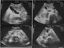 УЗД органів черевної порожнини хворого О. на 3-й день лікування УЗД органів черевної порожнини хворого О. на 3-й день лікування