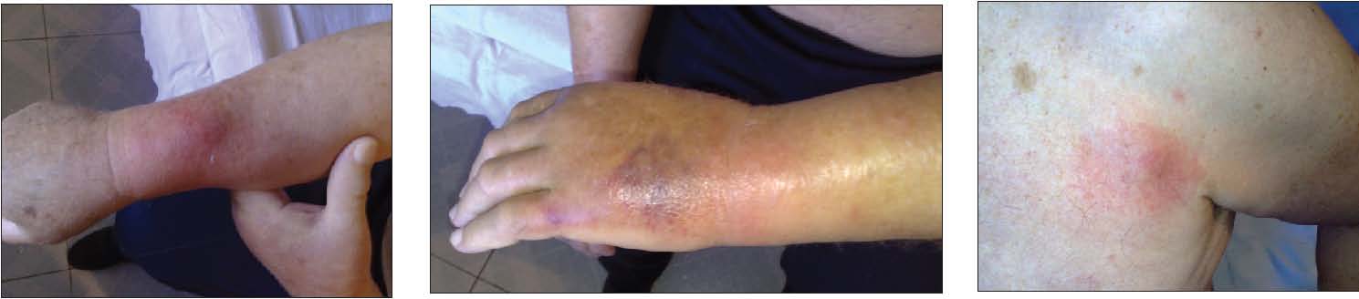 Фото изменений кожи больного Ч. на 5-й день лечения вариконазолом